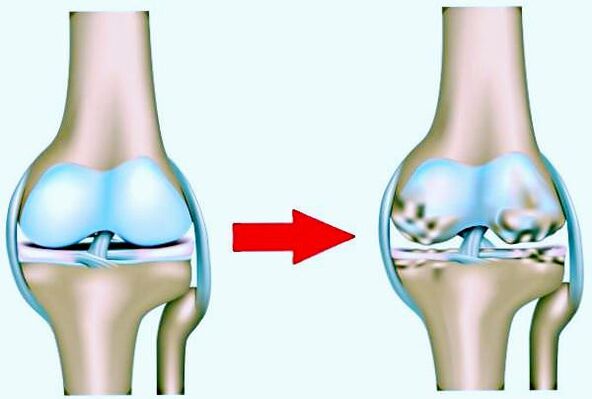 Articulation du genou normal et frappé par l'arthrose
