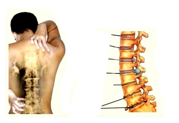 Phase de développement de l'ostéochondose