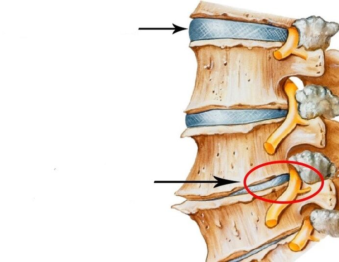disque endommagé et nerf violé avec une ostéochondose cervicale