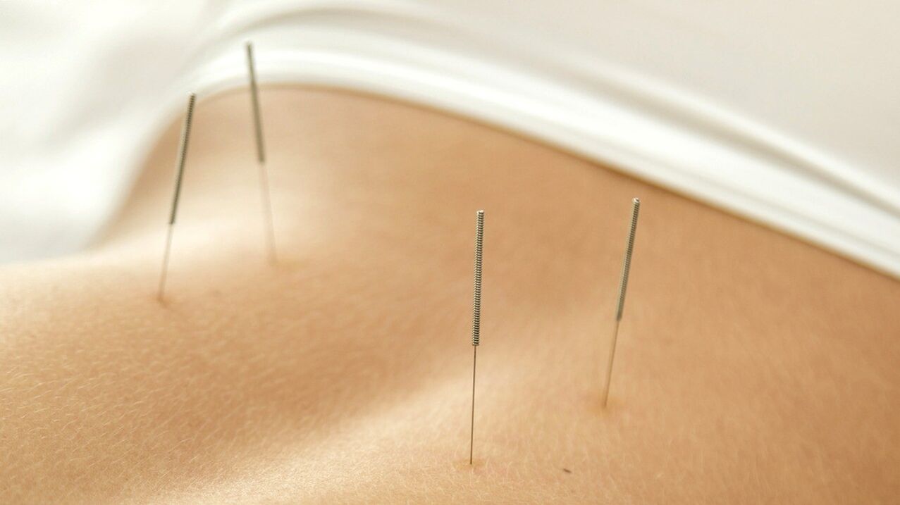 L'acupuncture aidera à se débarrasser des douleurs lombaires